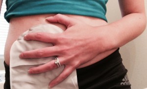 stephanie hughes stoma ostomy ileostomy stolen colon crohn's disease ulcerative colitis inflammatory bowel disease ibd blog blockage