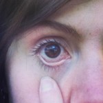 stephanie hughes eye ball iritis inflammation stolen colon ostomy crohns blog