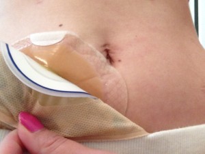 out of the bag shower bath bathing personal care clean water stephanie hughes stolen colon crohn's ostomy ileostomy colitis blog