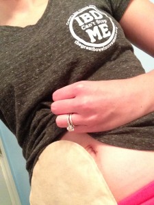 ostomy ibd inflammatory bowel disease ulcerative colitis ileostomy invisible illness stephanie hughes stolen colon blog