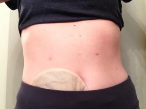 ostomy pants running run exercise training stephanie hughes stolen colon crohn's disease ulcerative colitis inflammatory bowel disease ibd blog