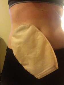 stoma colon ostomy ileostomy ileoscopy hospital procedure IV stomach stephanie hughes stolen colon crohn's disease ulcerative colitis inflammatory bowel disease ibd blog ostomy bag pouch