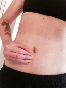 stephanie hughes stoma ostomy ileostomy stolen colon crohn's disease ulcerative colitis inflammatory bowel disease ibd blog