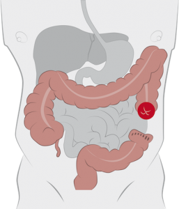 what-is-a-colostomy-image