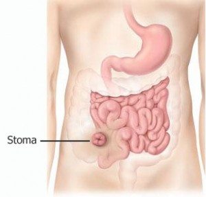 what-is-an-ileostomy-image