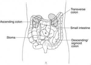 what-is-an-urostomy-image