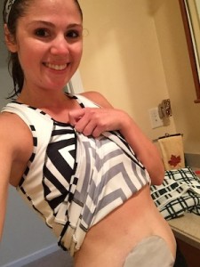 World Ostomy Day WannaWearOne 5k stephanie hughes out of the bag colostomy ileostomy crohn's disease ulcerative colitis inflammatory bowel disease ibd ostomy blog stolen colon top 10 reasons to have an ostomy ileostomy colostomy urostomy