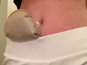 stephanie hughes out of the bag colostomy ileostomy crohn's disease ulcerative colitis inflammatory bowel disease ibd ostomy blog stolen colon top 10 reasons to have an ostomy ileostomy colostomy urostomy out of the bag passing gas farting
