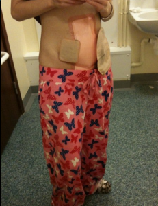 thaila ostomy bags