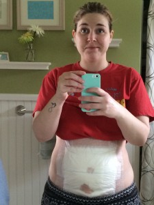 Lindsey Russell colostomy jpouch crohn's story OstoMYstory stoma ostomy crohn's disease ulcerative colitis ileostomy colostomy urostomy inflammatory bowel disease ibd stolen colon
