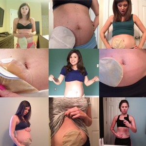 Lets talk about ostomies