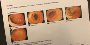 stolen colon inflammatory bowel disease crohn's